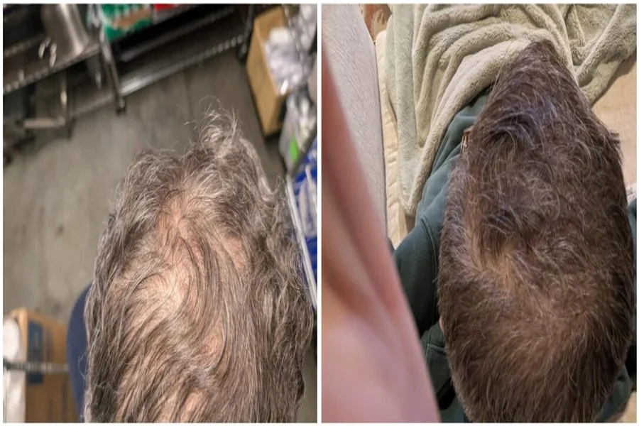 Topical Dutasteride for Hair Growth and Thicker Hair