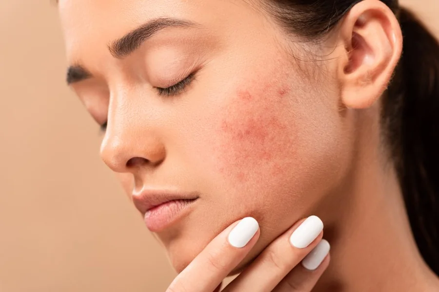 Textural Healing: How an Acne Marks Reduction Cream Smooths Clog-Prone Skin